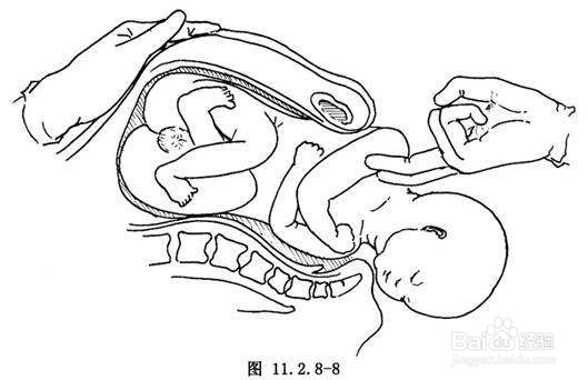 肩难产处理图片