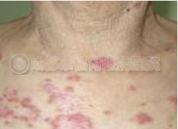 过敏性紫癜肾炎有哪些临床症状