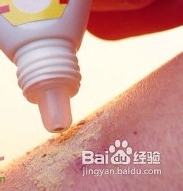 牛皮癣患者秋冬季节皮肤瘙痒怎么办