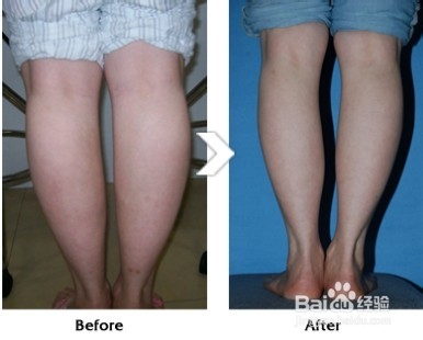 如何快速瘦小腿