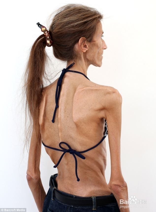 世界第一瘦女子讲述减肥危害