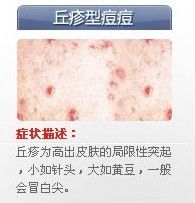 痘痘的种类有哪些