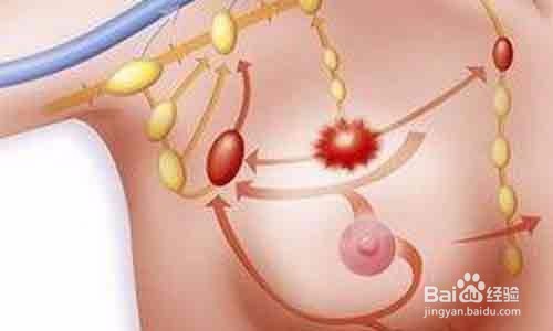 乳房做了微创怎么消肿