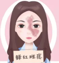 鲜红斑痣能彻底治愈吗?鲜红斑痣治疗费用?