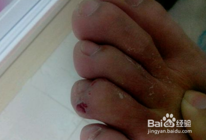 生了脚气怎么办