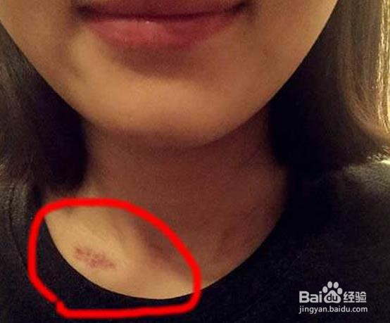 脖子吻痕怎么消除