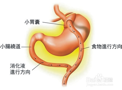 如何治疗肥胖纹