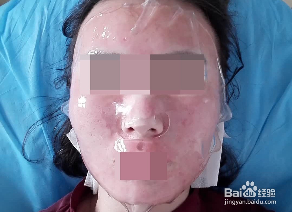 第一次做微针射频手术