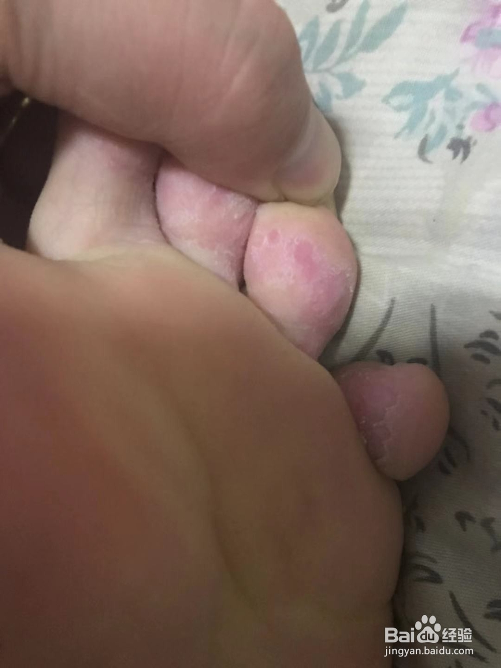 脚趾缝长小水泡很痒应该怎么办