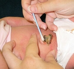 如何对新生儿的脐带进行护理