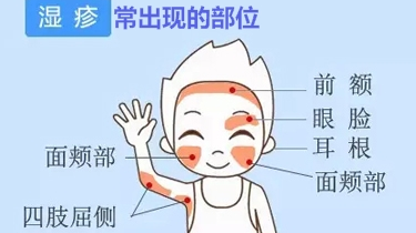 如何治愈反复发作的宝宝湿疹