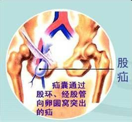 带你认识常见病：[17]腹外疝