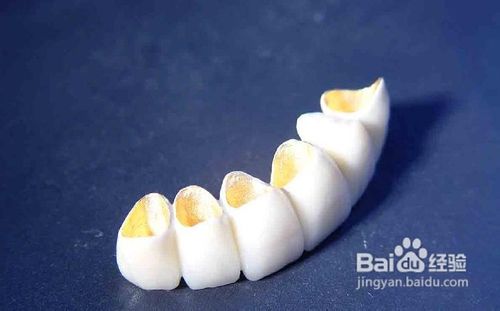 烤瓷牙什么材料好