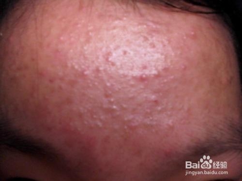 额头上长痘痘的预防及治疗