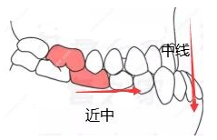 安氏一类二类三类怎样分