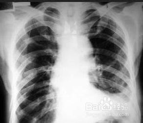 骨折愈合的时间