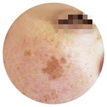 肝不好，脸上多半有4种现象