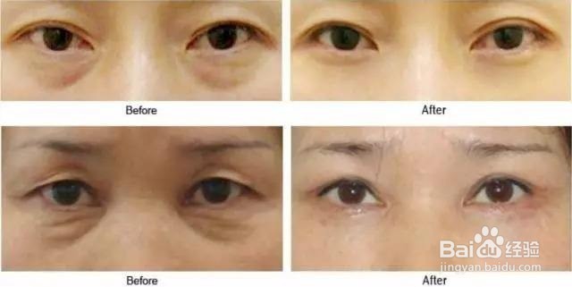 眼袋怎样去除好