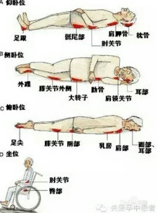 怎样预防压疮 百度经验