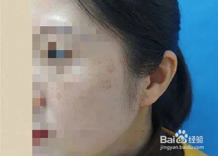 老年斑的危害是什么?老人斑快速消除方法有啥?