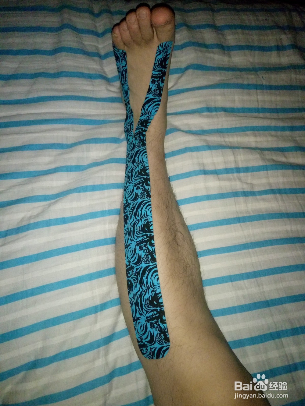 脑卒中后足下垂内翻的贴扎治疗