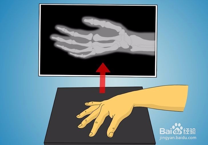 如何诊断拇指是否骨折?