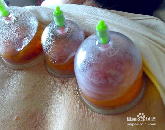 拔罐祛湿吗,拔罐祛湿效果好吗？