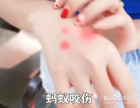 被蚂蚁咬伤了怎么办