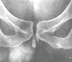 如何认识“肾结石”