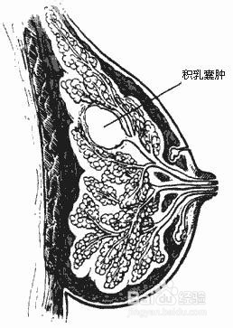 乳腺癌有什么症状