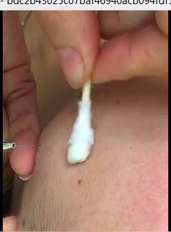 点痣笔的操作方法