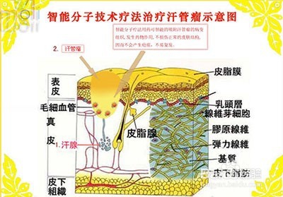 哪些运动对预防汗管瘤有好处？