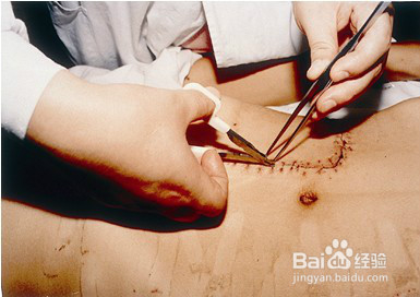 皮肤吻合器使用步骤和拆钉器使用方法