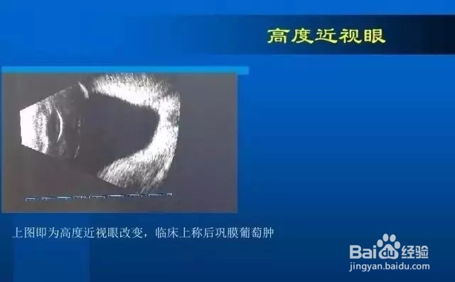 几种常见眼病B超图谱及诊断