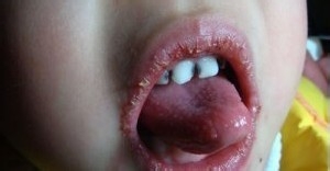 造成唇炎的原因