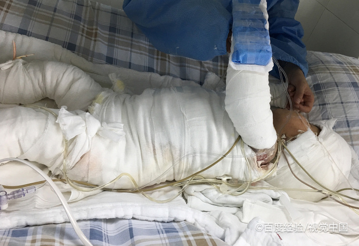 烫伤处理的正确方法是什么