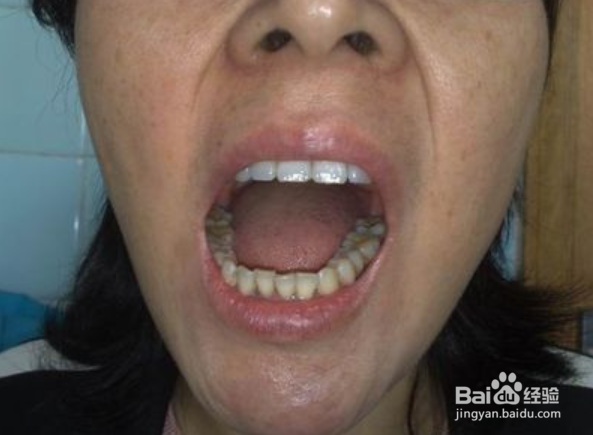 如何分辨髁突肥大