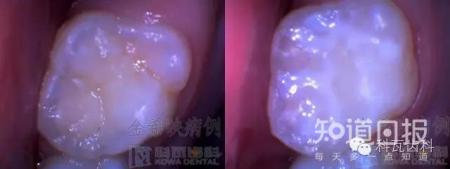 孩子六龄齿窝沟封闭有必要吗?九成父母都不知道