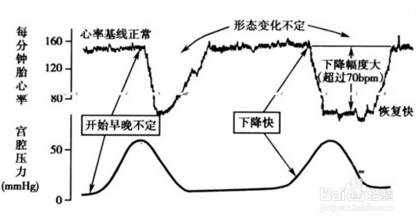 胎心监护加速减速是什么为什么胎心监护曲线平