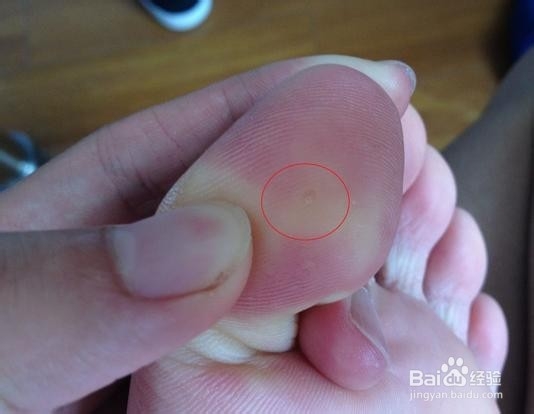 预防长鸡眼的方法有哪些_百度经验