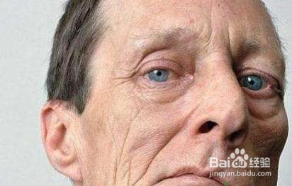 梅杰综合证与中医