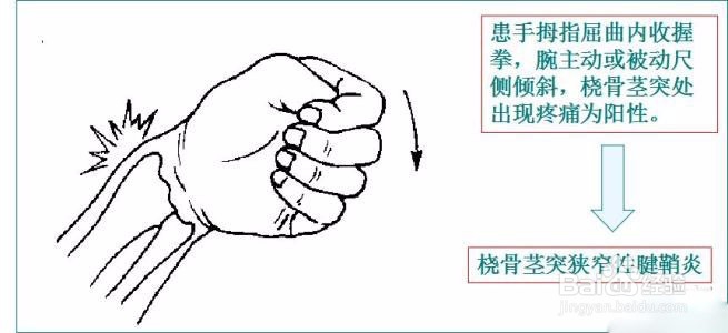 什么是腱鞘炎