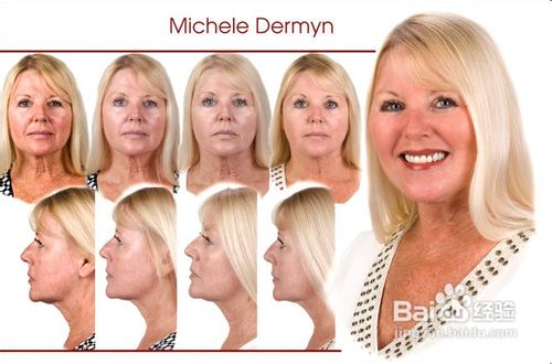 抗衰老歼灭眼角皱纹怎么去鱼尾纹