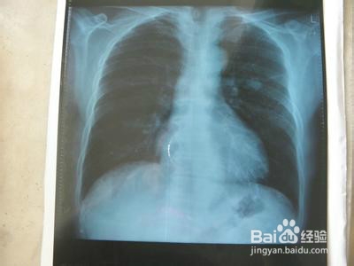 咳嗽,恶心,干呕怎么办