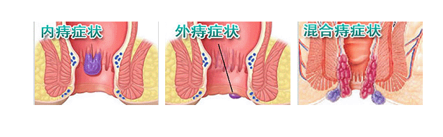 如何预防与治疗痔疮