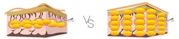 什么是填脂肪、自体脂肪填充大约需要多少钱？