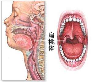 扁桃体癌的简便自查方法 百度经验