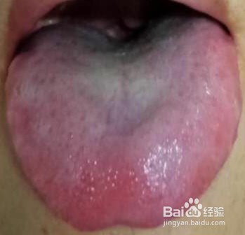 什么是灼口综合征?
