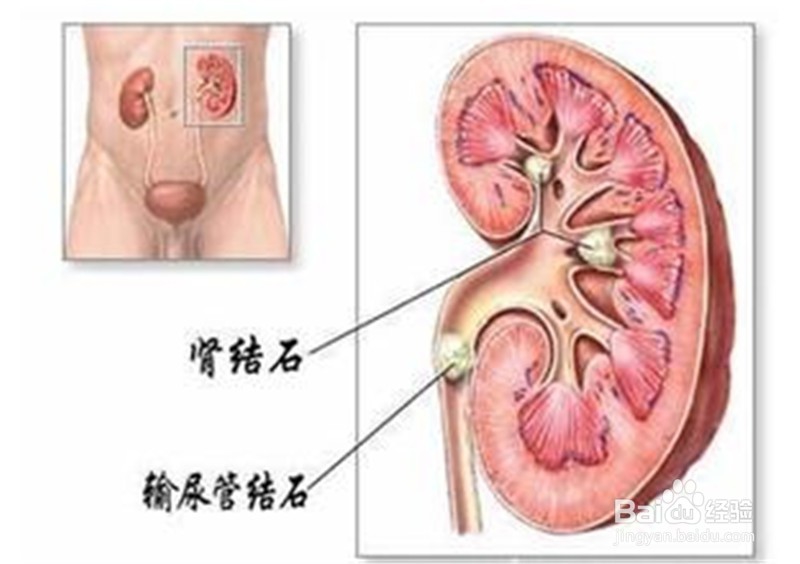 喝奶能引发肾结石吗