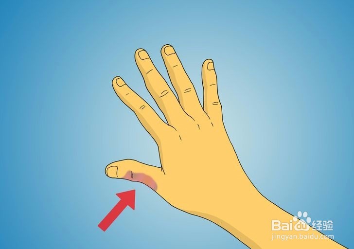 如何诊断拇指是否骨折?